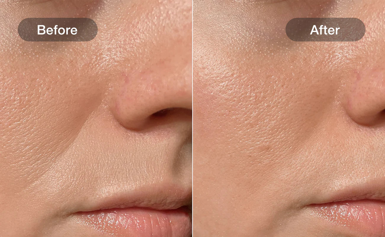 Skin texture improvement, before and after 28 days with NOORA
