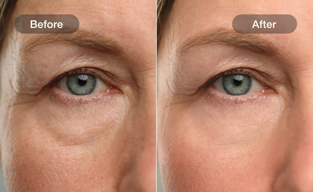 Reduced redness around eyes, before and after 28 days with NOORA