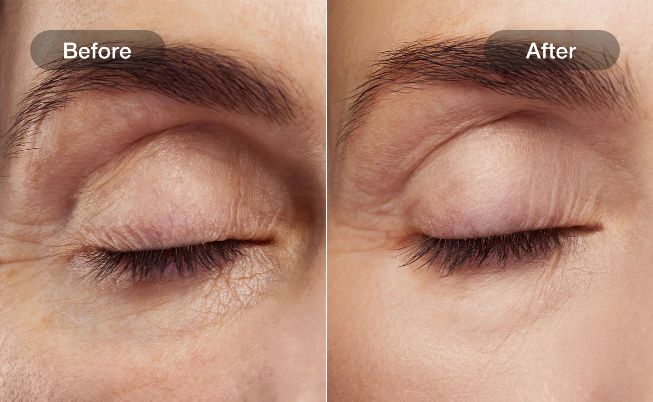 Pore refinement and smoother skin, before and after with NOORA